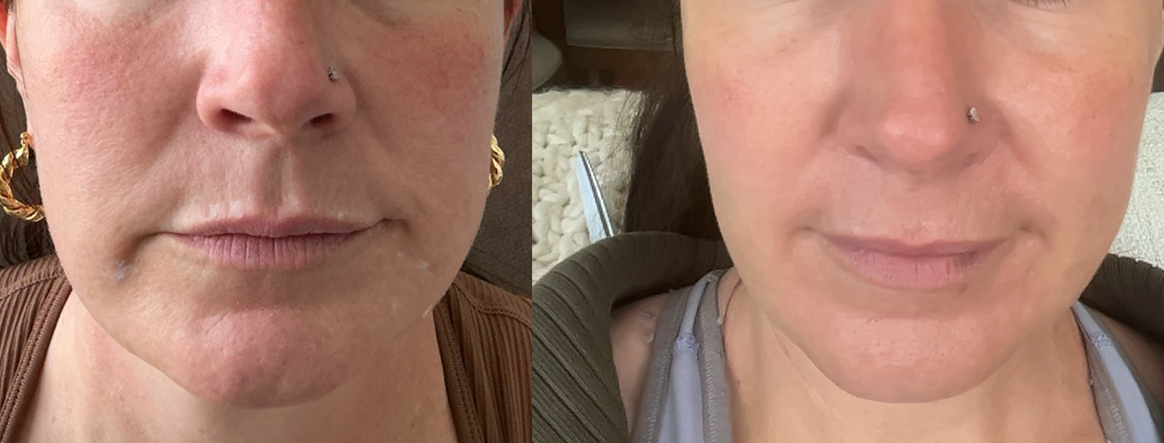 Before and after lower face neuromodulator result