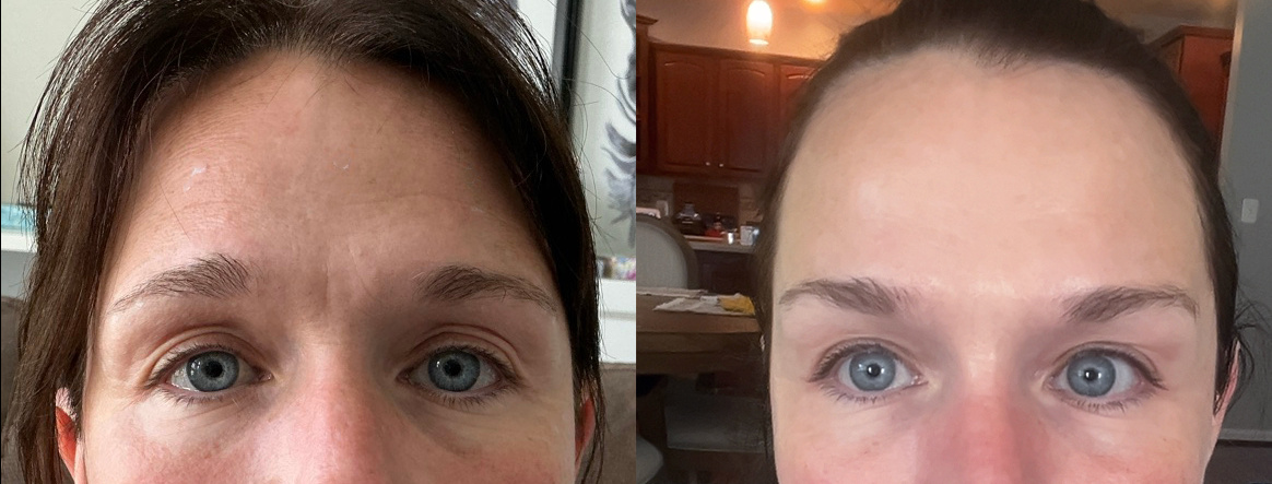 Before and after upper face neuromodulator result
